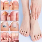 Generic Fungal Nail Patches (Yellow) - Image 3